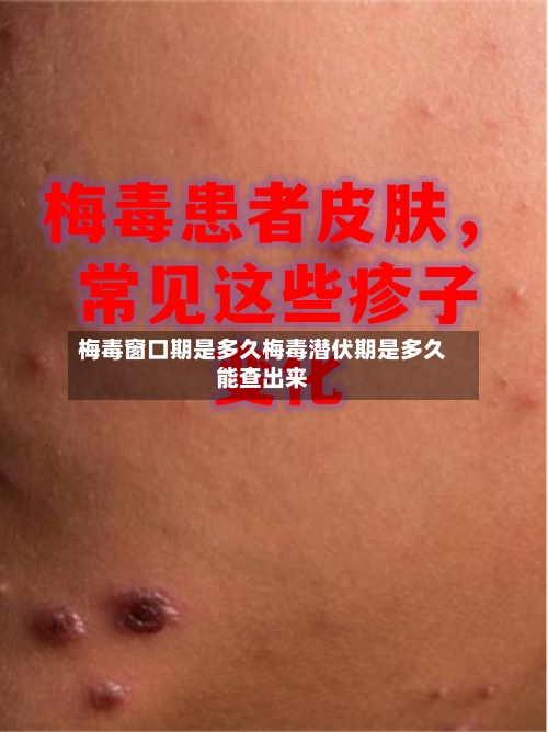 梅毒窗口期是多久梅毒潜伏期是多久能查出来