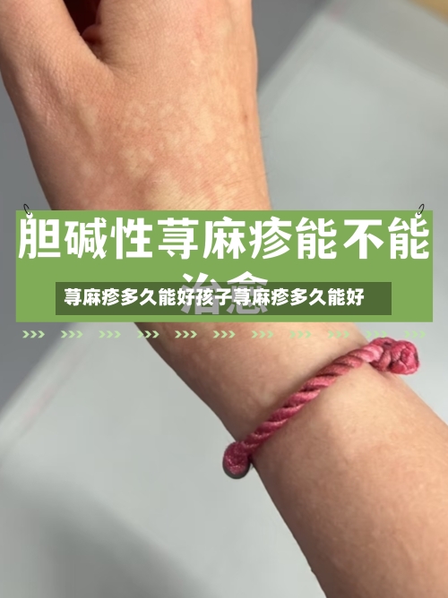 荨麻疹多久能好孩子荨麻疹多久能好