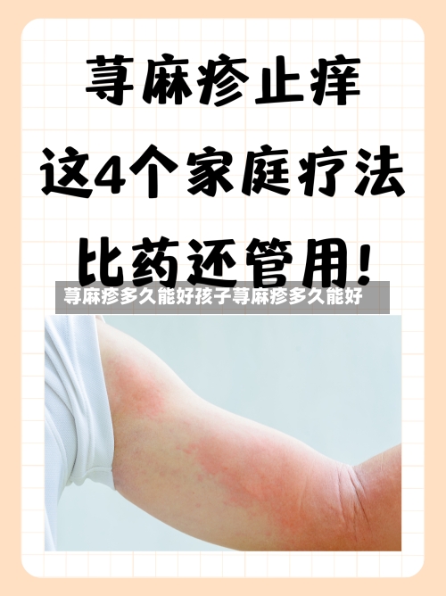 荨麻疹多久能好孩子荨麻疹多久能好