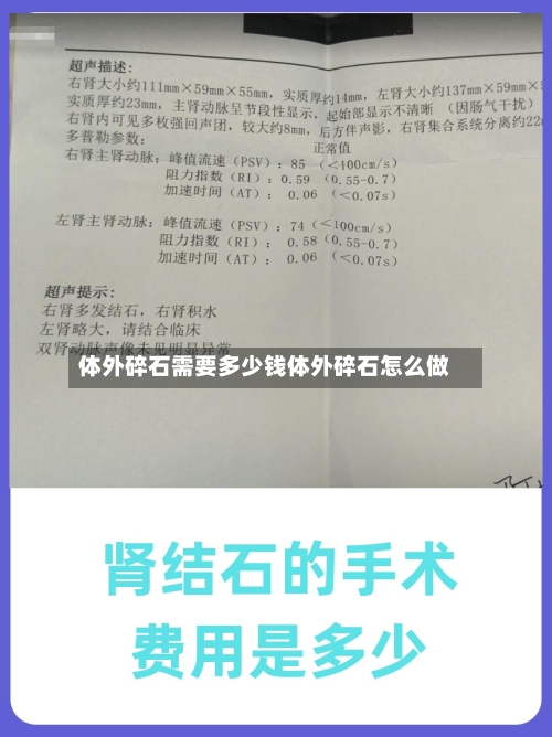 体外碎石需要多少钱体外碎石怎么做